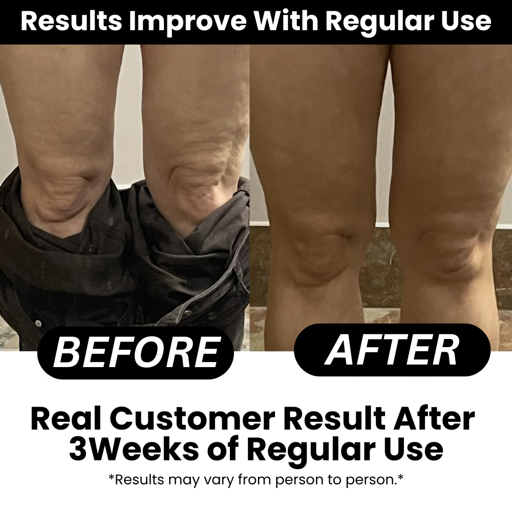 SmoothRise™ anti-cellulite massagerulle