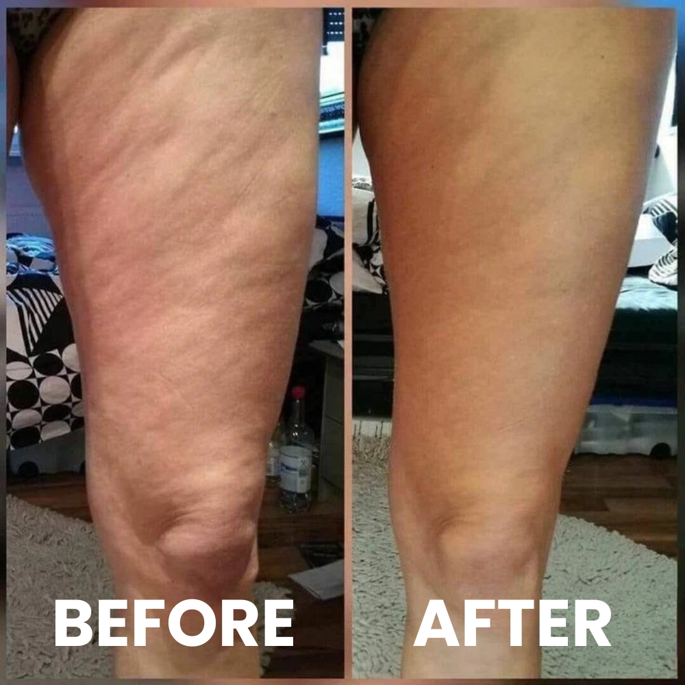 SmoothRise™ anti-cellulite massagerulle
