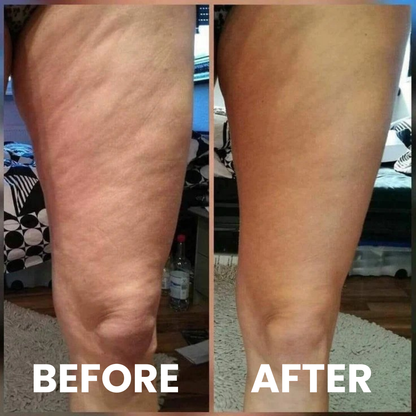 SmoothRise™ anti-cellulite massagerulle