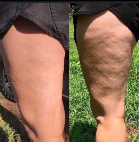 Anti-cellulite massageolie